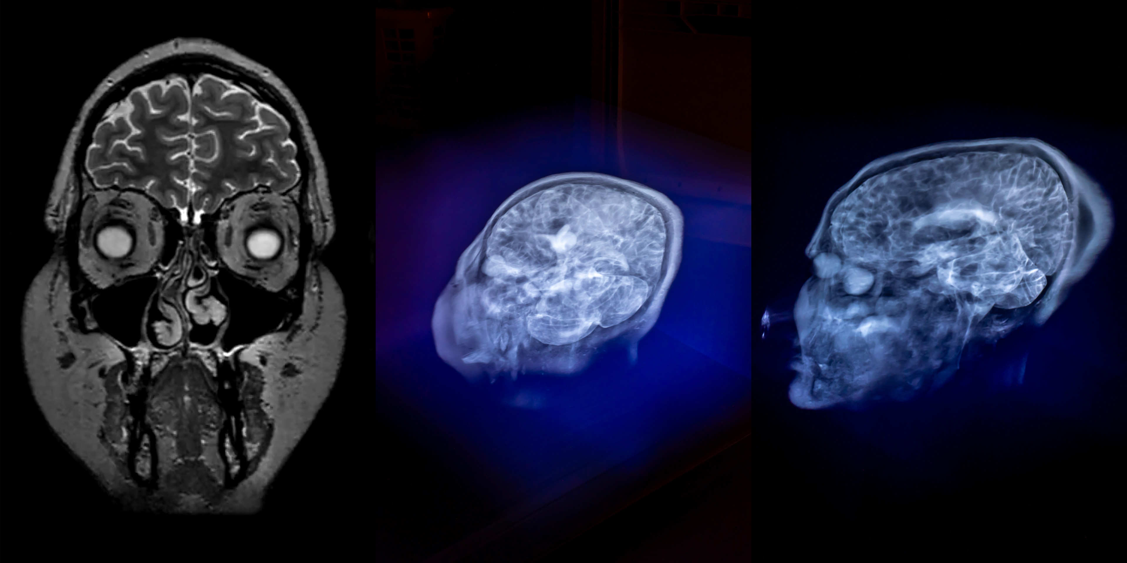 early linear-actuator test with an MRI scan